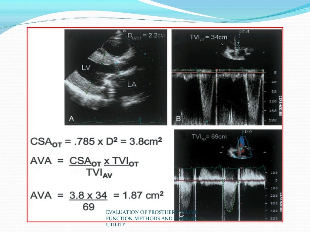 Evaluation of prosthetic valve function and clinical utility.