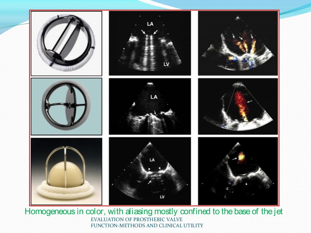 Evaluation of prosthetic valve function and clinical utility.