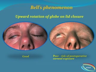 Ptosis workup | PPTX