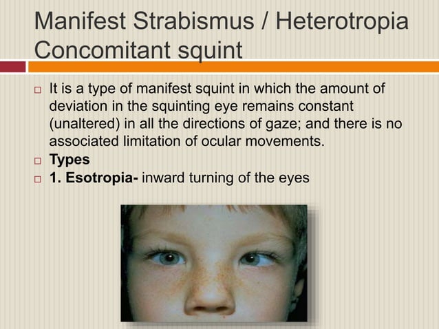 Evaluation of squint | PPT
