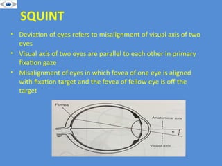 Visual Squint EVALUATION OF SQUINT . MOTOR AND SENSORY EXAMINATION | PPTX