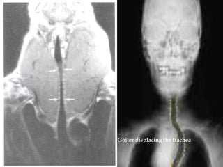 Nodular goiter




                 Goiter displacing the trachea
 