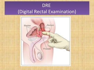 Points to be noted in DREPoints to be noted in DRE
• Size of the prostate May be enlarged
• Surface Smooth
• Consistency F...