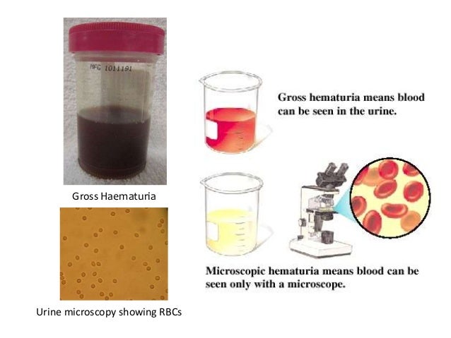 1. Причины гематурии