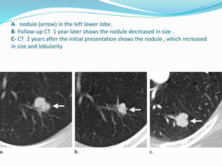 Evaluation of the solitary pulmonary nodule (radiographics) | PPTX