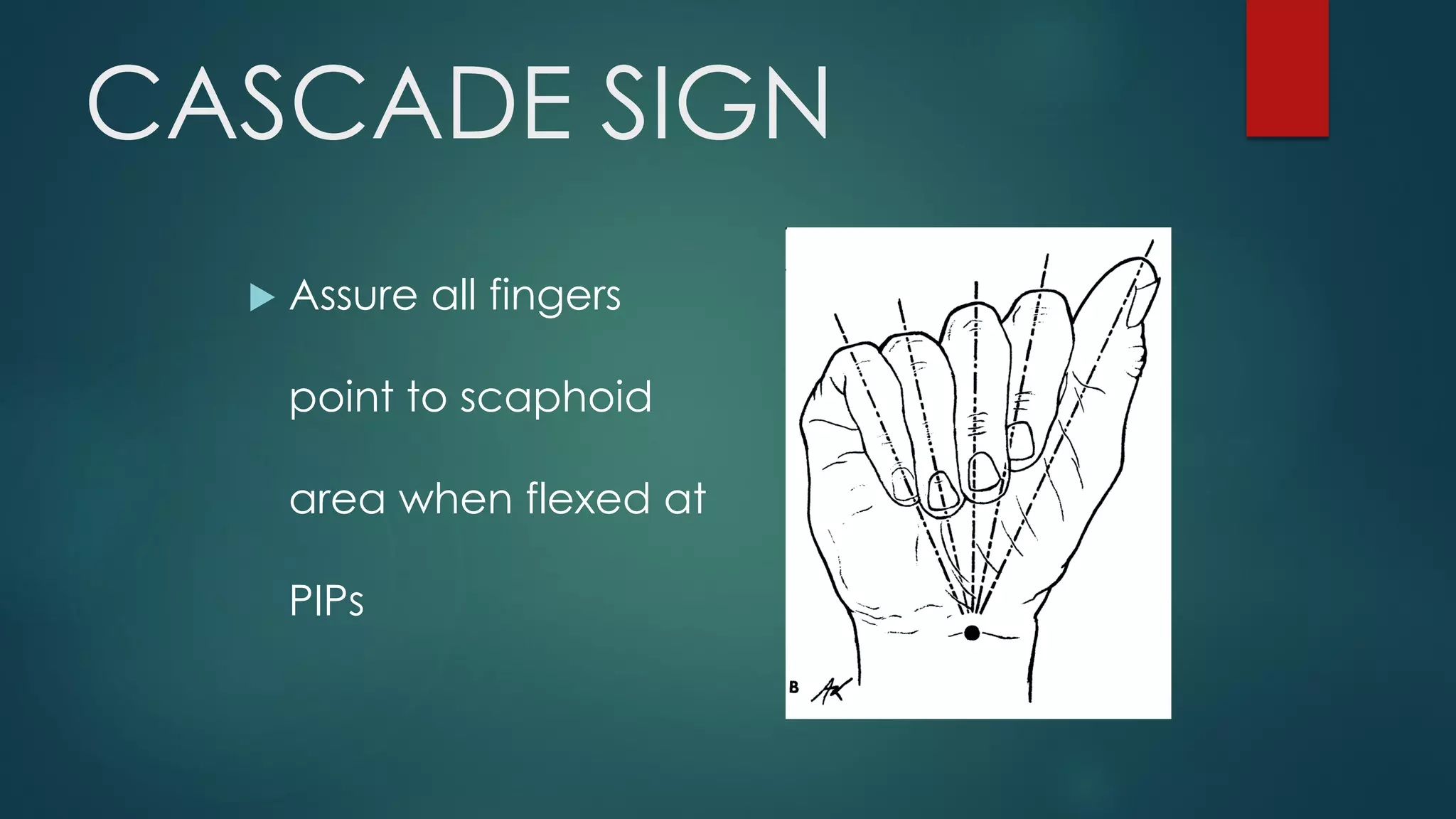 CASCADE SIGN
 Assure all fingers
point to scaphoid
area when flexed at
PIPs
 