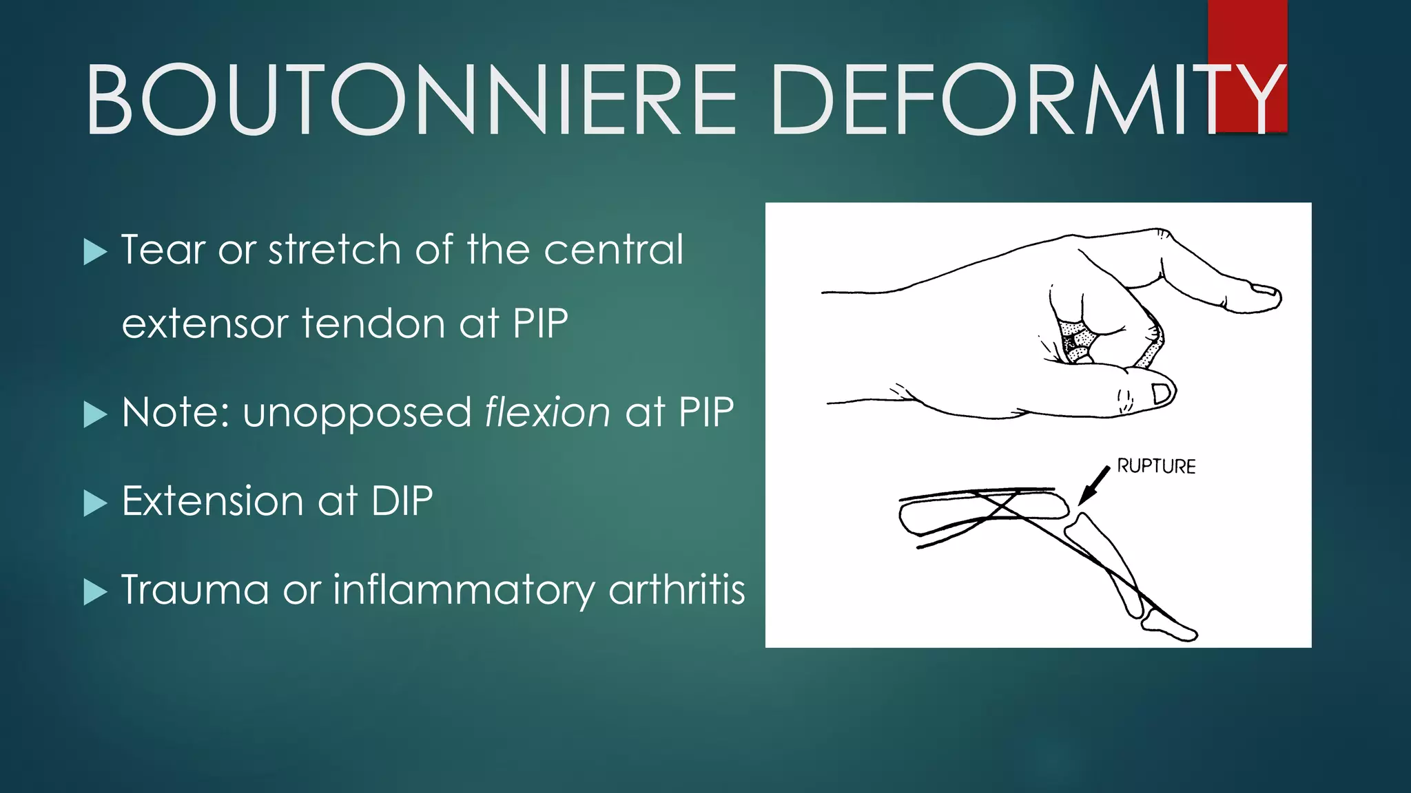 BOUTONNIERE DEFORMITY
 Tear or stretch of the central
extensor tendon at PIP
 Note: unopposed flexion at PIP
 Extension at DIP
 Trauma or inflammatory arthritis
 