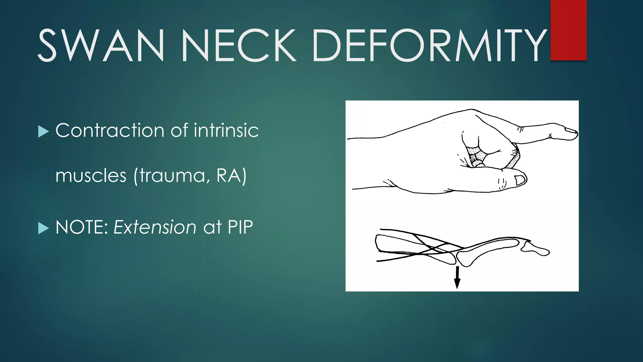 SWAN NECK DEFORMITY
 Contraction of intrinsic
muscles (trauma, RA)
 NOTE: Extension at PIP
 