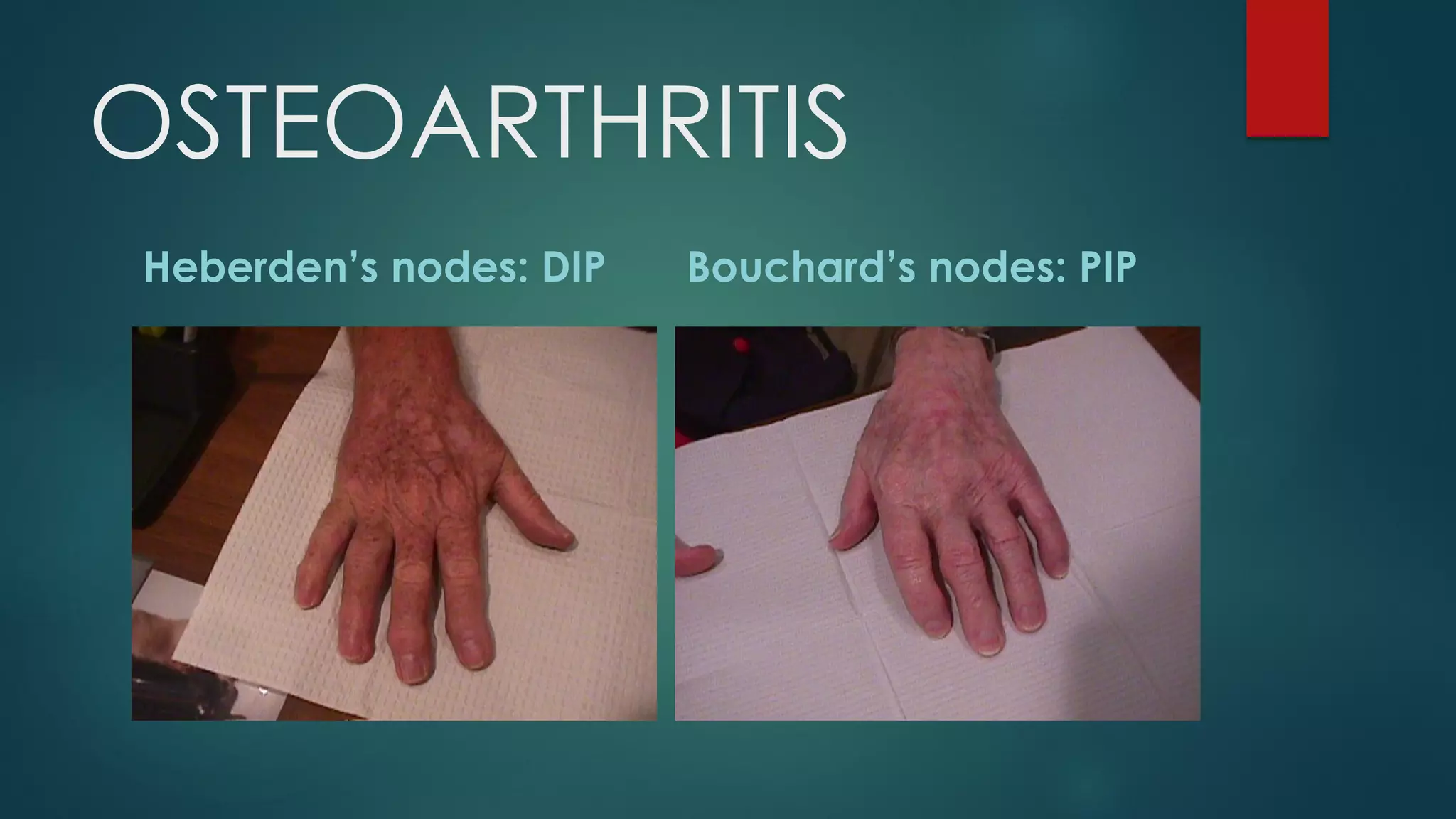 OSTEOARTHRITIS
Heberden’s nodes: DIP Bouchard’s nodes: PIP
 