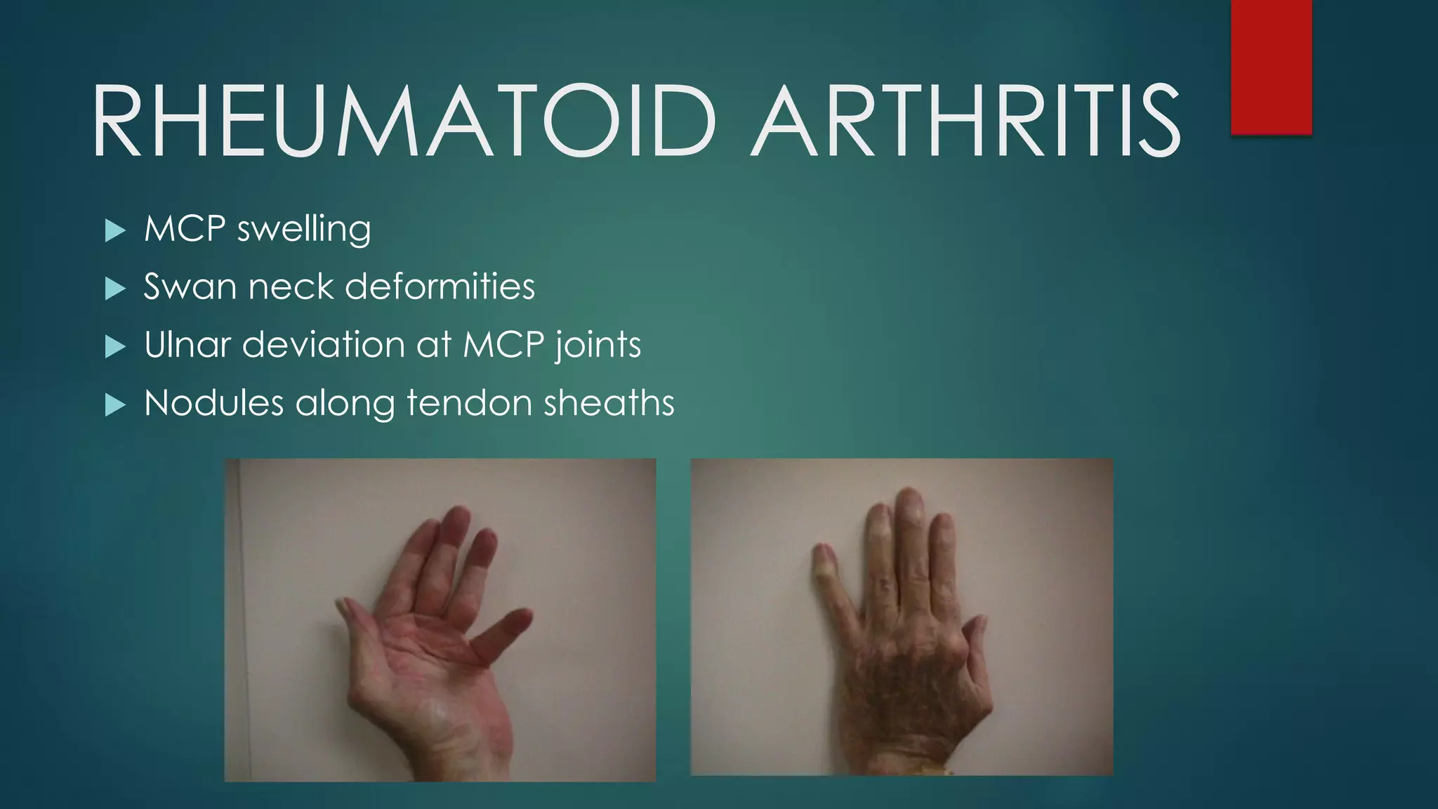 RHEUMATOID ARTHRITIS
 MCP swelling
 Swan neck deformities
 Ulnar deviation at MCP joints
 Nodules along tendon sheaths
 