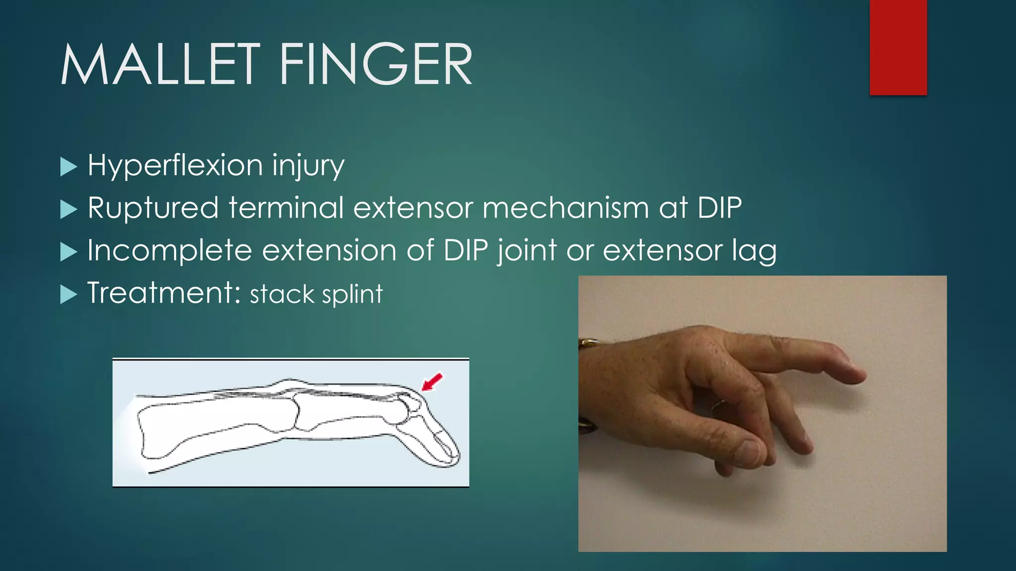 MALLET FINGER
 Hyperflexion injury
 Ruptured terminal extensor mechanism at DIP
 Incomplete extension of DIP joint or extensor lag
 Treatment: stack splint
 