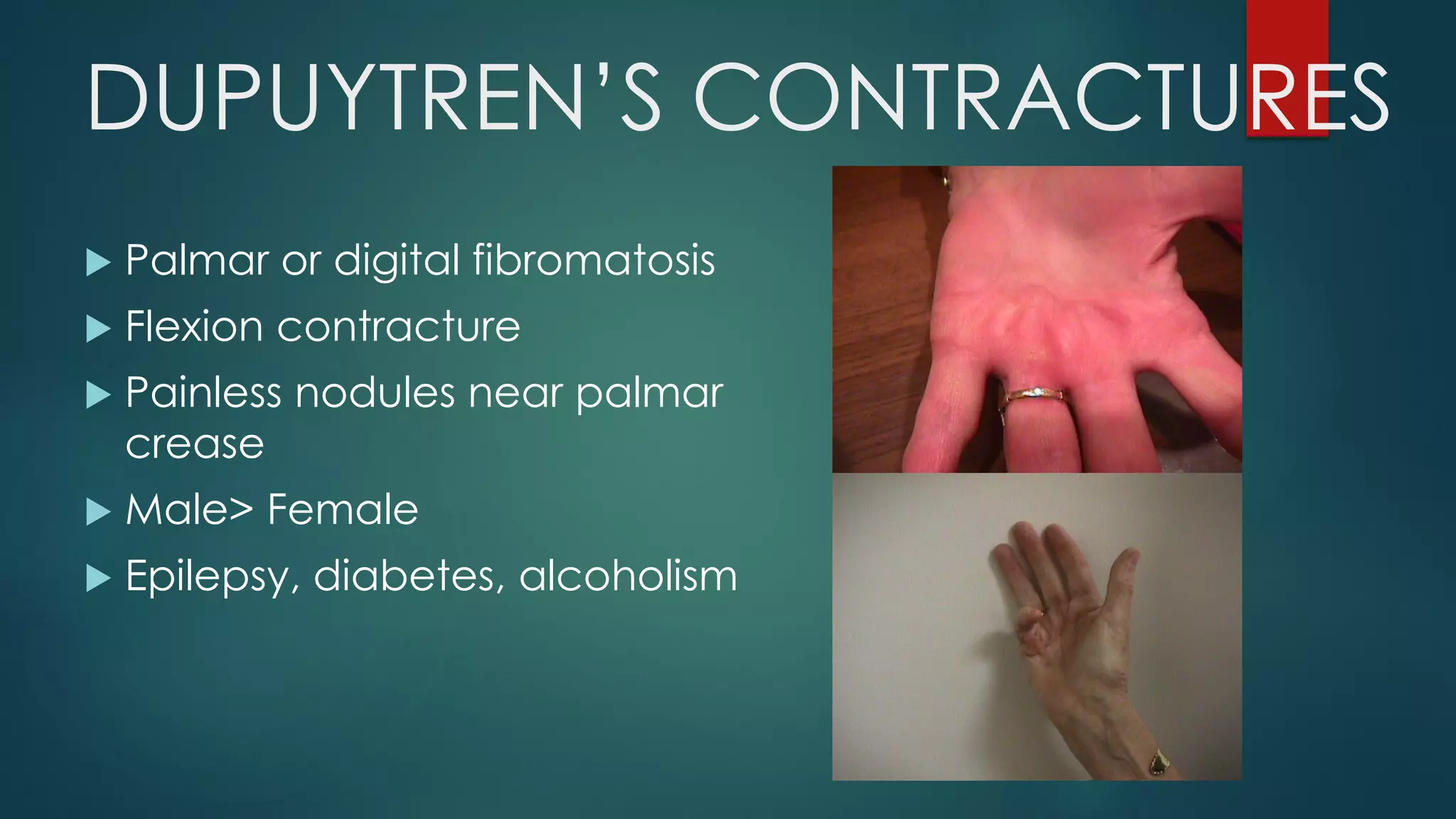 DUPUYTREN’S CONTRACTURES
 Palmar or digital fibromatosis
 Flexion contracture
 Painless nodules near palmar
crease
 Male> Female
 Epilepsy, diabetes, alcoholism
 