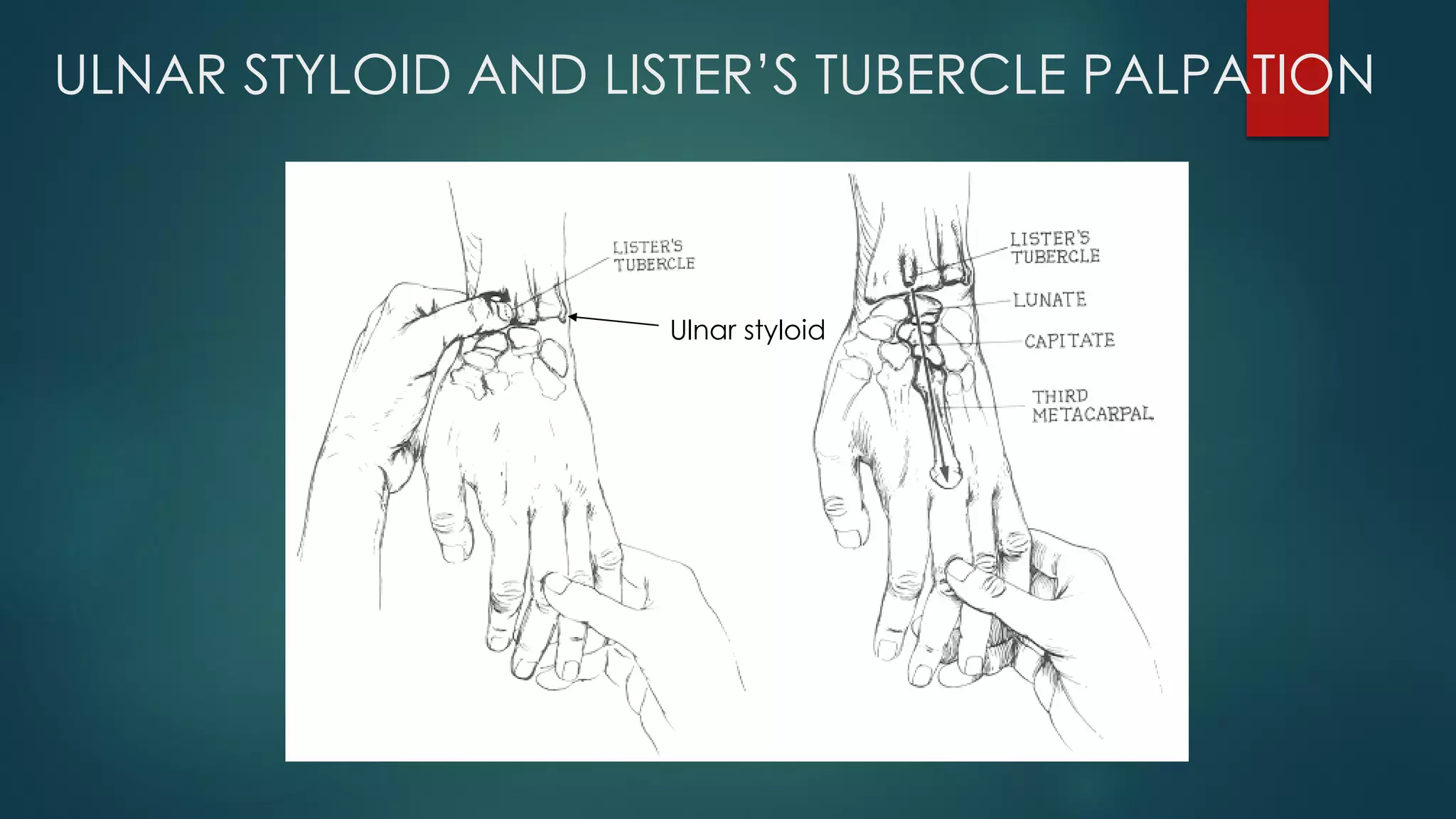 ULNAR STYLOID AND LISTER’S TUBERCLE PALPATION
Ulnar styloid
 