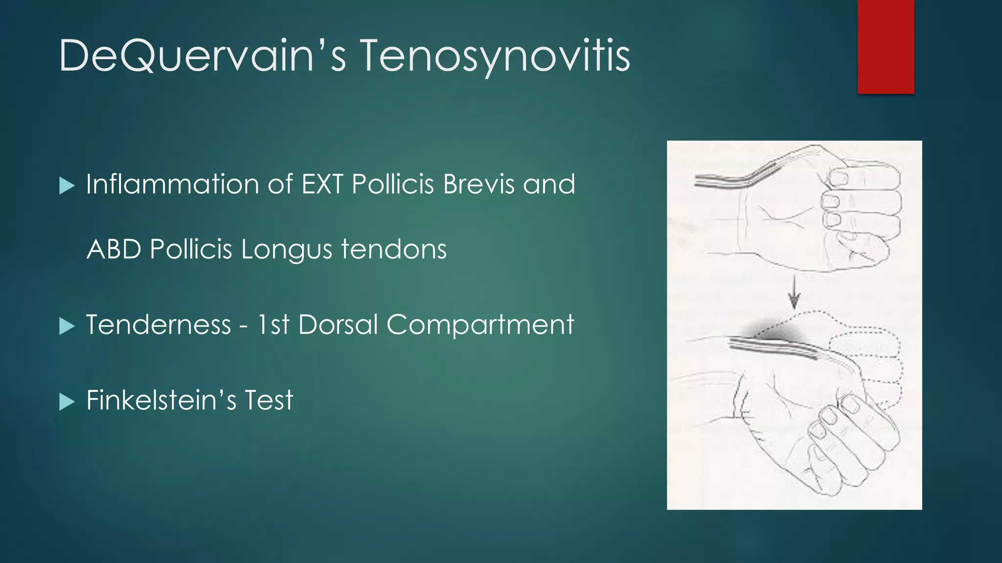 DeQuervain’s Tenosynovitis
 Inflammation of EXT Pollicis Brevis and
ABD Pollicis Longus tendons
 Tenderness - 1st Dorsal Compartment
 Finkelstein’s Test
 