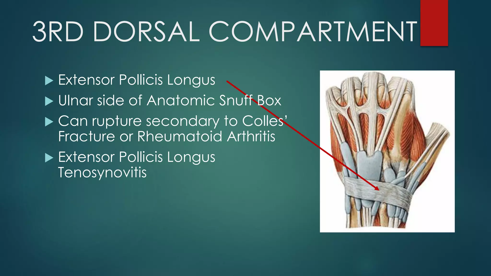 3RD DORSAL COMPARTMENT
 Extensor Pollicis Longus
 Ulnar side of Anatomic Snuff Box
 Can rupture secondary to Colles’
Fracture or Rheumatoid Arthritis
 Extensor Pollicis Longus
Tenosynovitis
 