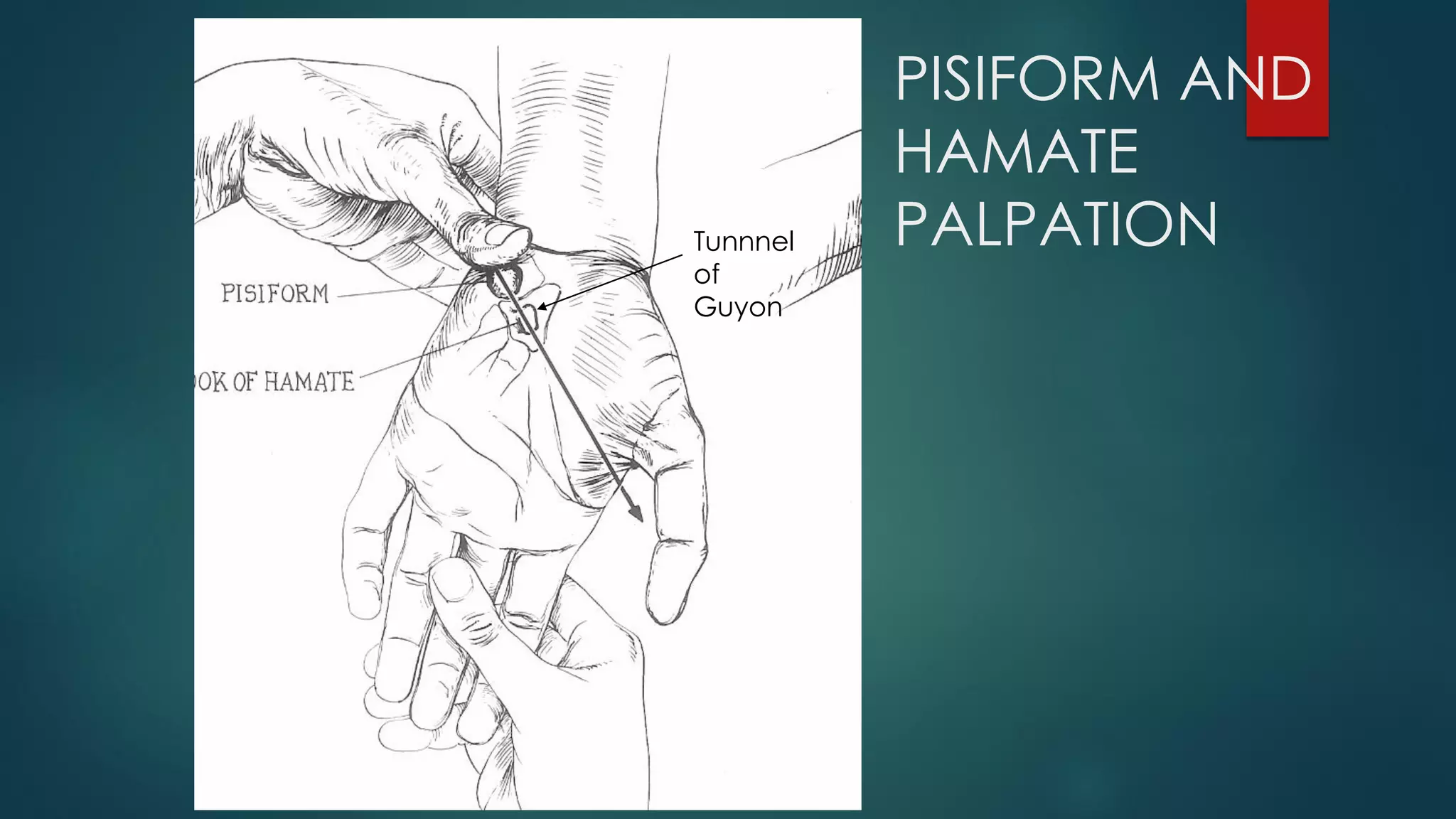 PISIFORM AND
HAMATE
PALPATIONTunnnel
of
Guyon
 