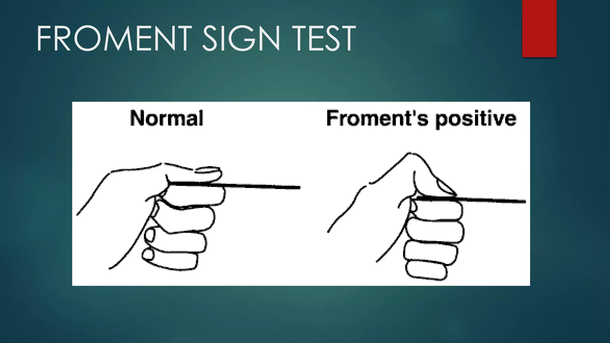 FROMENT SIGN TEST
 