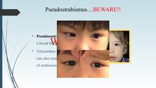 Pseudostrabismus…BEWARE!!
What is it???
• Pseudoesotropia as a result of
a broad bridge of the nose.
• Telecanthus or hypertelorism
can also result in mis-diagnosis
of strabismus.
 