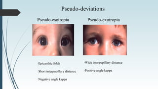 Pseudo-deviations
Pseudo-esotropia Pseudo-exotropia
•Epicanthic folds
•Short interpupillary distance
•Negative angle kappa
•Wide interpupillary distance
•Positive angle kappa
 