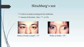 Reflex at border of pupil = 15°° Reflex at limbus = 45°°
Hirschberg‘s test
 Used as an initial screening test for strabismus.
 Amount of deviation: 1mm = 7° or 15Δ
 
