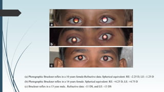 (a) Photographic Bruckner reflex in a 10 years female:Refractive data:.Spherical equivalent: RE: -2.25 D, LE: -1.25 D
(b) Photographic Bruckner reflex in a 14 years female. Spherical equivalent: RE: +4.25 D, LE: +4.75 D
(c) Bruckner reflex in a 13 year male.. Refractive data: -11 DS, and LE: -13 DS
 