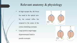 • In high myopia the, the fovea
lies nasal to the optical axis.
So, the corneal reflex lies
temporal to the center of the
cornea simulating esotropia.
• Large positive angle kappa
(hypermetropia) leads to
pseudo-exotropia.
Relevant anatomy & physiology
 