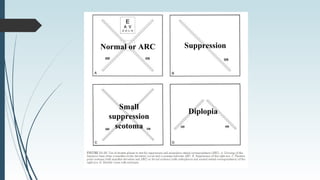 Normal or ARC
Diplopia
Suppression
Small
suppression
scotoma
 