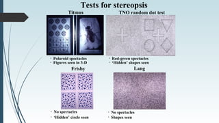 Tests for stereopsis
Titmus
• Red-green spectacles
TNO random dot test
• ‘Hidden’ shapes seen
• Polaroid spectacles
• Figures seen in 3-D
Lang
• No spectacles
Frisby
• ‘Hidden’ circle seen
• No spectacles
• Shapes seen
 