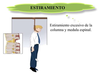 Estiramiento excesivo de la
columna y medula espinal.
ESTIRAMIENTO
 