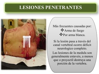 LESIONES PENETRANTES
Más frecuentes causadas por:
Arma de fuego
Por arma blanca.
Si la lesión pasa a través del
canal vertebral ocorre déficit
neurologico completo.
Las lesiones de la medula son
generalmente estaveis, a menos
que o proyectil destruya una
porción de la vertebra.
 