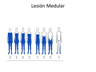 Lesión Medular
 