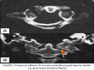 FIGURA 2: Fractura de Jefferson. En el corte coronal (B) se puede observar también
uno de los trazos de fractura (flecha)
 