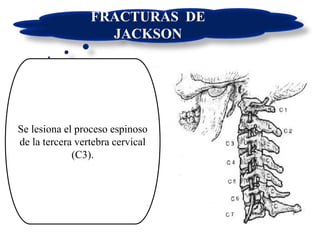 FRACTURAS DE
JACKSON
Se lesiona el proceso espinoso
de la tercera vertebra cervical
(C3).
 