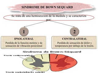 Se trata de una hemiseccion de la medula y se caracteriza
por:
CONTRALATERAL
Perdida de sensación de dolor y
temperatura por debajo de la lesión.
IPSOLATERAL
Perdida de la función motora y de
sensación de vibración posicional
1 2
SINDROME DE BOWN SEQUARD
 