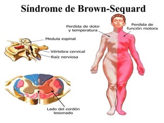 Síndrome de Brown-Sequard
Medula espinal
Raíz nerviosa
Vértebra cervical
Perdida de dolor
y temperatura
Perdida de
función motora
Lado del cordón
lesionado
 