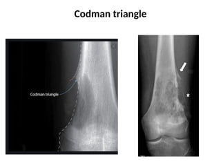 clinical approach to evalution of bone tumours | PPTX