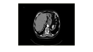 Eva R 35 Aneurisma de aorta abdominal y toracica EVAR TEVAR | PPTX