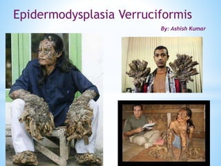 Epidermodysplasia Verruciformis
By: Ashish Kumar
 