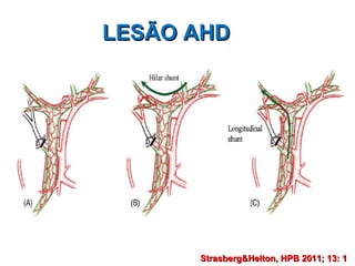 LESÃO AHD Strasberg&Helton, HPB 2011; 13: 1   