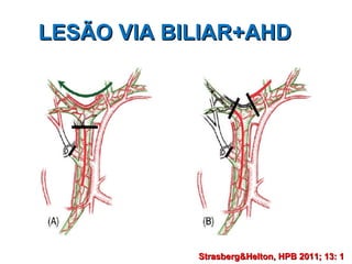 LESÃO VIA BILIAR+AHD Strasberg&Helton, HPB 2011; 13: 1   