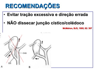 RECOMENDAÇÕES Evitar tração excessiva e direção errada NÃO dissecar junção cístico/colédoco McMahon, BJS, 1995; 82: 307 
