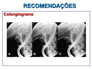 RECOMENDAÇÕES Colangiograma 