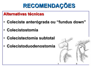 RECOMENDAÇÕES Alternativas técnicas Coleciste anterógrada ou “fundus down” Colecistostomia Colecistectomia subtotal Colecistoduodenostomia 