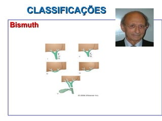 CLASSIFICAÇÕES  Bismuth 