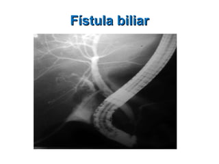Fístula biliar 