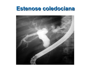 Estenose coledociana 