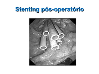 Stenting pós-operatório 