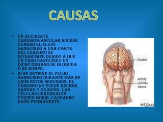 Un accidente cerebrovascular sucede cuando el flujo sanguíneo a una parte del cerebro se interrumpe debido a que un vaso sanguíneo en dicho órgano se bloquea o se rompe. Si se detiene el flujo sanguíneo durante más de unos pocos segundos, el cerebro no puede recibir sangre y oxígeno. Las células cerebrales pueden morir, causando daño permanente.