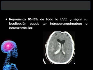 • Representa 10-15% de toda la EVC, y según su
localización puede ser intraparenquimatosa o
intraventricular.

 