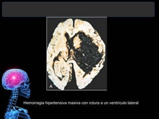 Hemorragia hipertensiva masiva con rotura a un ventrículo lateral

 